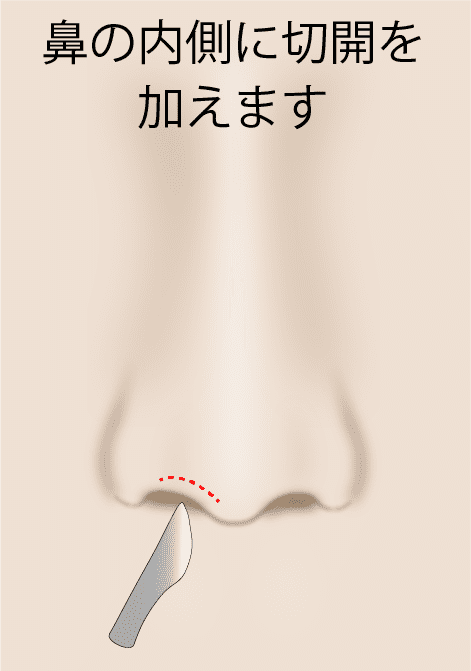 ②鼻の内側を切開